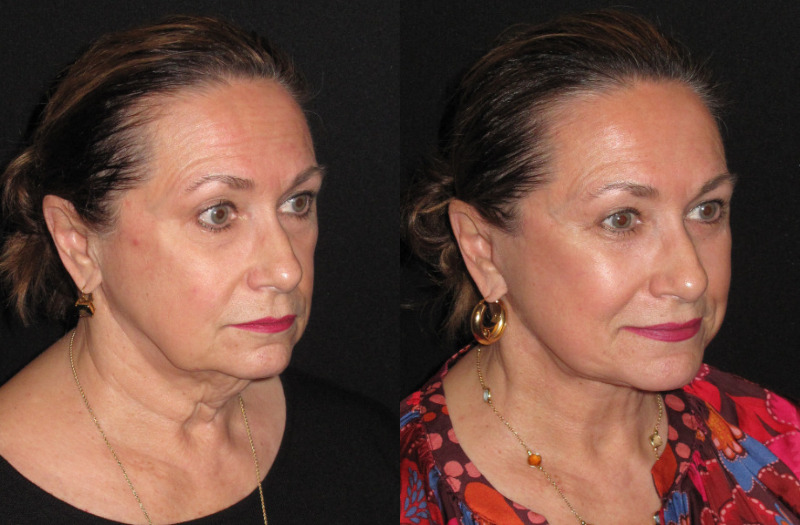 Patient 88 Combined Image