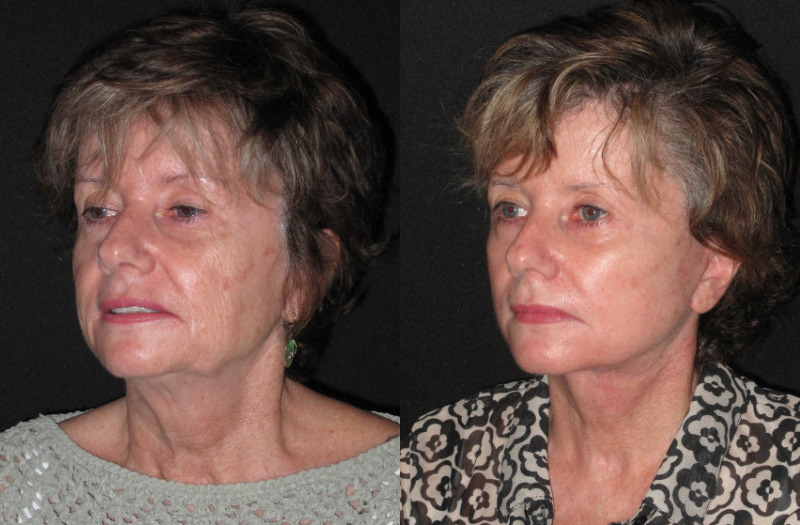 Patient 85 Combined Image