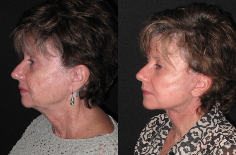 Patient 85 Combined Image