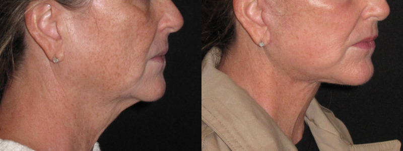 Patient 83 Combined Image