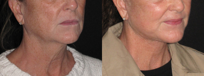 Patient 83 Combined Image