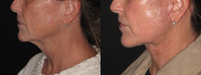 Patient 83 Combined Image