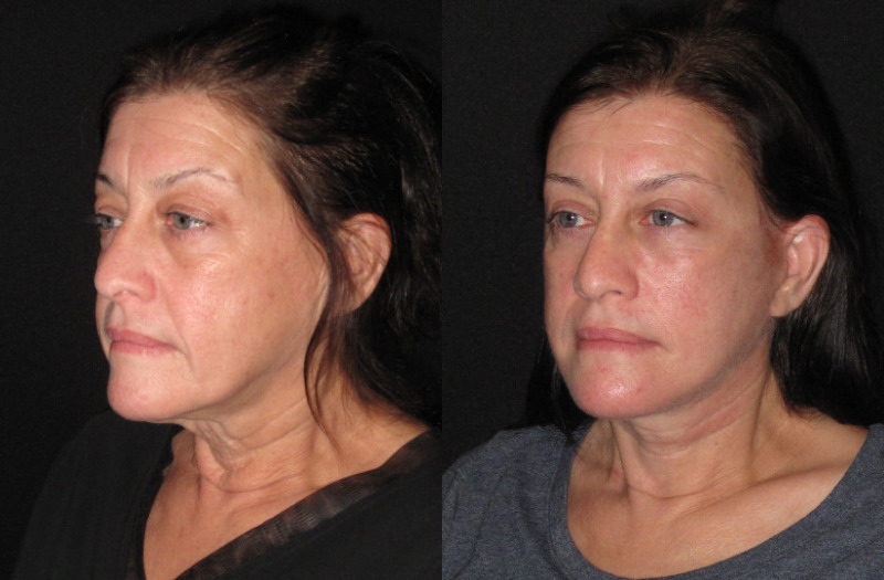 Patient 86 Combined Image