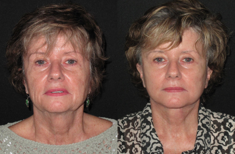 Patient 85 Combined Image