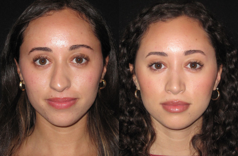 Patient 82 Combined Image