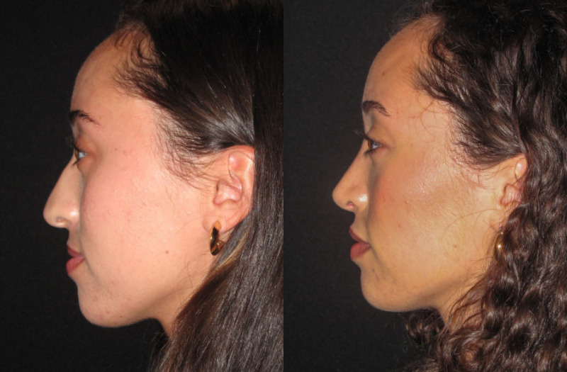 Patient 82 Combined Image