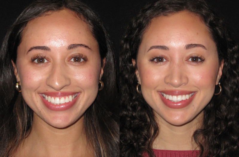 Patient 82 Combined Image