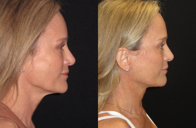 Patient 90 Combined Image