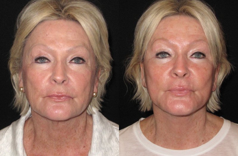 Patient 91 Combined Image