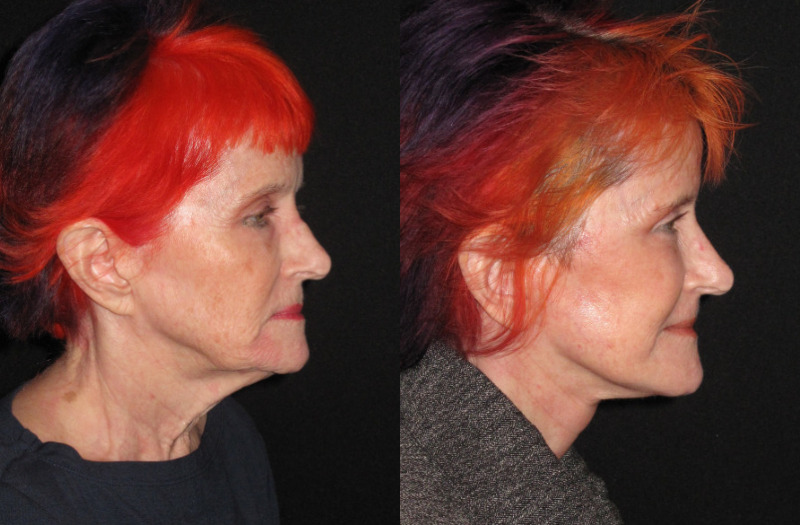 Patient 93 Combined Image