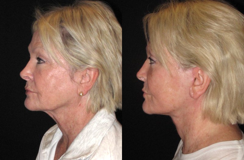 Patient 91 Combined Image