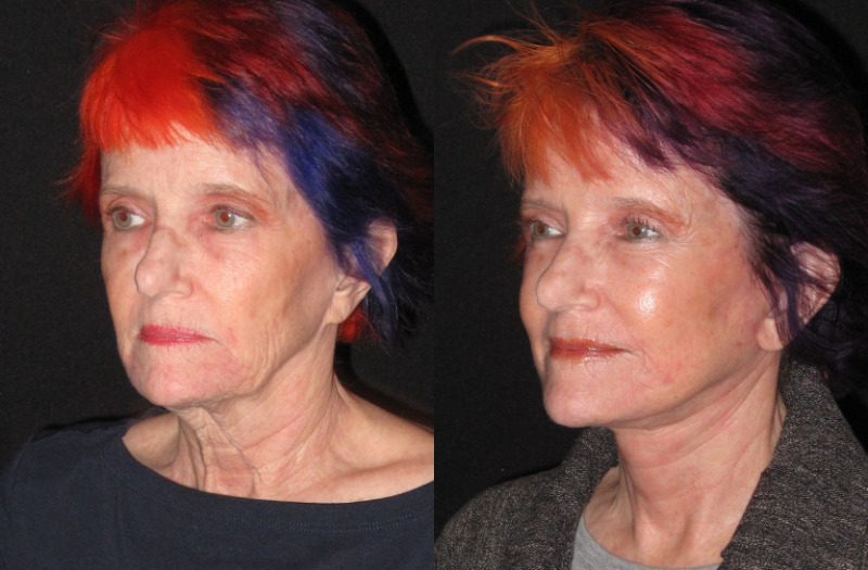 Patient 93 Combined Image