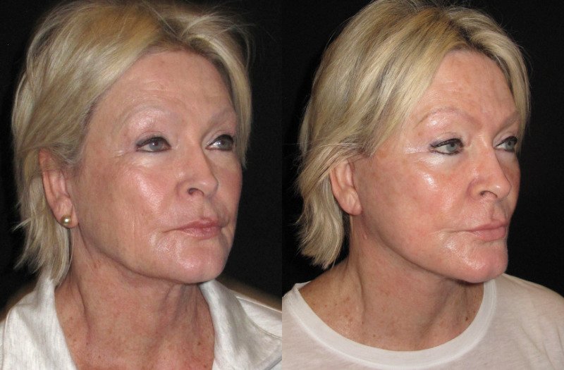 Patient 91 Combined Image